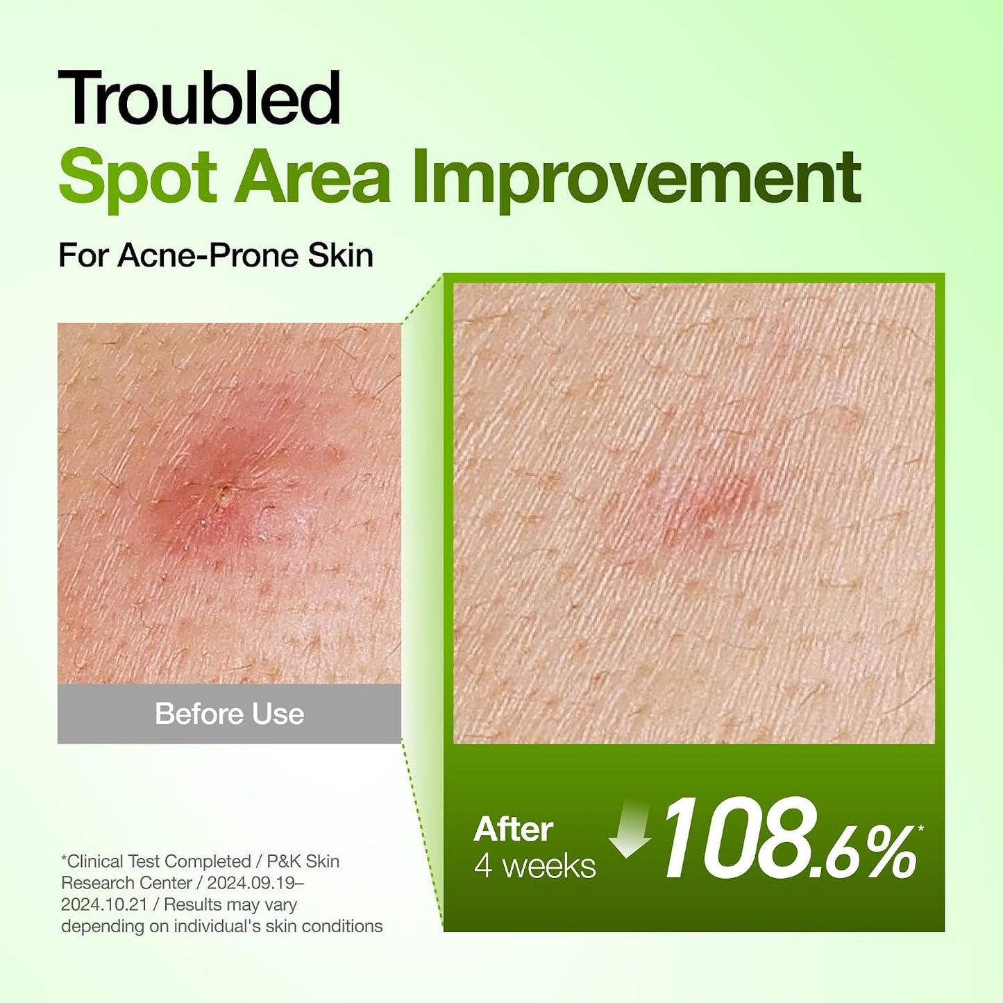 ANUA - Azelaic Acid 10 Hyaluron Redness